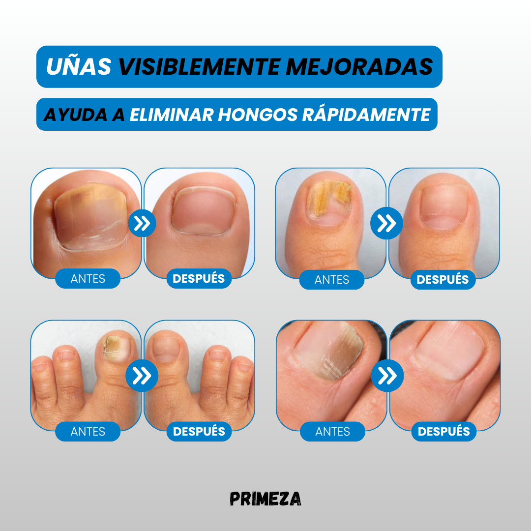 OnyVera™ – Elimina los hongos de raíz y recupera tus uñas desde el primer día