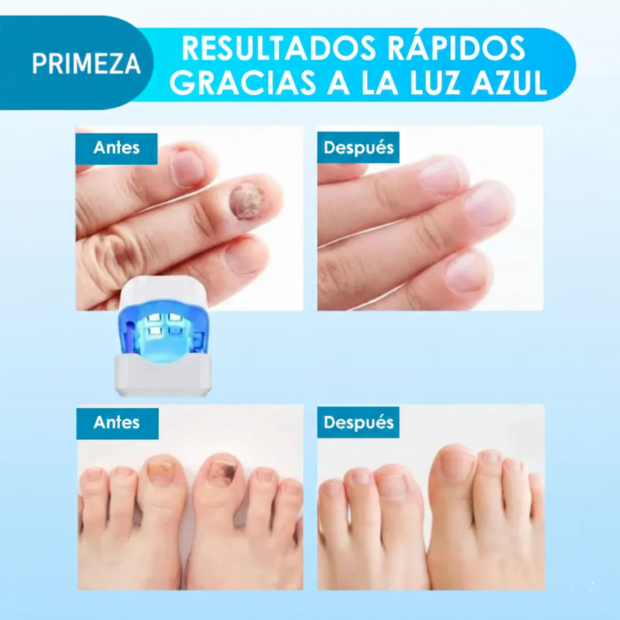 Dispositivo Láser para Hongos en las Uñas